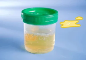 Đi tiểu có vàng mỡ là bệnh gì