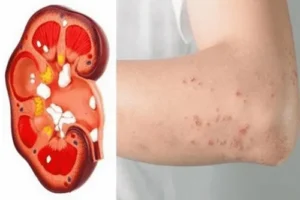 Suy thận giai đoạn 1 có biểu hiện gì