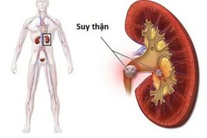 Tại sao suy thận lại tiểu nhiều